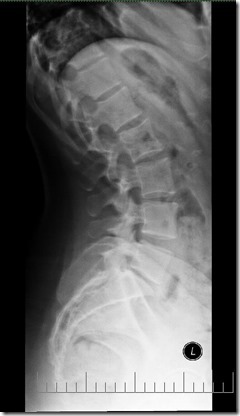 Lumbar Xray - Lateral L Spine